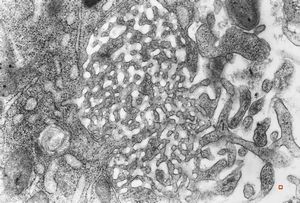 M,66y. | bone marrow - tubuloreticular complex